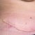 Scar line at 4 weeks post op.