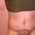 Post Op Day 18 (6-8-12)
(scar and BB is scabbing over ewwww! Going to start Mederma hopefully today)