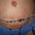 1 week post op - tummy tuck close up