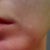 Day 91 after ePrime procedure (using elure Advanced Skin Lightening and two Vitalize peels)