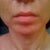 Day 91 after ePrime procedure (still has swelling, especially left side of face, neck and shoulder)