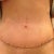 8 Days Post Op. First look at scar.