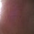 24 HOUR POST TREATMENT - LEFT