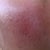 24 HOUR POST TREATMENT - RIGHT