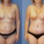 before and one week PO