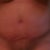 After seroma drained