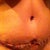 This is about 5 or 6 days PO. Still in the Recovery Boutique. I had a vertical scar in center of belly because bb was too high so he had to cut so I wouldn't have stretch marks (knew before surgery). I thought this looked good :/