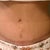 Tummy Tuck revision 2 weeks post op...note below my bellon button is another incision which was my old belly button, which shows you how much skin was still able to be pulled down
