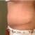 Tummy Tuck revision 2 weeks post op