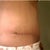 Tummy Tuck revision 2 weeks post op