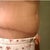 Tummy Tuck revision 2 weeks post op....still pretty swollen on lower abdomin
