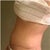 Tummy Tuck revision 2 weeks post op
