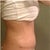 Tummy Tuck revision 2 weeks post op