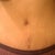 Tummy Tuck 3 weeks post-op.....you can see my swelling in my hips are going down and yu can also see where i had to have my old belly button fixed, but the scar will not be very visable after it heal