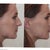 Computer simulation of what my nose will look like after surgery..