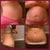 before with hernia (top)
4 weeks post op (bottom) still swollen