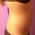 Side 2 weeks post-procedure