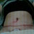 Post op day 3, starting to swell a bit