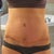 3 weeks po, incision is healing really nicely, not a fan of belly button yet but not that concerned about it.