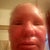 48 hours after fraxel. very swollen. no more oozing. everything going good.
