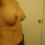 Side view pre-op 200cc implants
