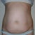 Before surgery