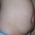 Before surgery