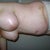After surgery day 9