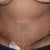 First look at tummy 4 days post op! haven't even showered yet!