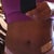 Day 4- very swollen but compression line is gone and skin is tighteninbg