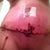 1 week PO. Very swollen and brusied and not nearly as sore as I thought I would be.