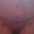 2 week PO. Just had my drains removed as well as Steri-strips. Some swelling has reduced and is easier to move around.