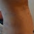 24 hours Post Op