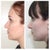 LEFT PROFILE: before (left) and 2.5 months post-op (right)