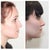 RIGHT PROFILE: before (left) and 2.5 months post-op (right)