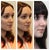 RIGHT 3/4: before (left), morphed image Dr. B created (middle), and 2.5 months post-op (right)