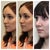 LEFT 3/4: before (left), morphed image Dr. B created (middle), and 2.5 months post-op (right)