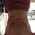 2 weeks post-op, slight bend over (notice how theirs less 'rolls' as compared to before).
