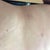 2 weeks post-op, cannula puncture sites. Not bad! Healing quickly, applying scar reducing cream on them daily.