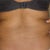 back love handles