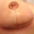 Righty. Loving the Bio Oil!!! Still swollen. This is the side I popped a stitch on. I also think this side is a little larger than the other, but, I am still very happy!!!