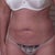 week 2, skin a little loose on lower abs but not bad