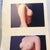Before Photos-other angle. These are the only photos my surgeon had in his file for me and he took out the originals and gave them to me, during my last and final visit. The spots are on the photo, not on my skin.