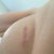 my left breast from below--April 8th 2013 (surgery was on Dec 11th 2012)-incision clearly not in the correct place