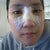 when they had to switch different splint cast since the other one looked really bad.. My nose looks really huge on this one.