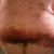 Postop Day 5 lipo bruising