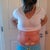 Post op day# 7 (1 week)