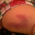 close up of one of my bruises