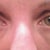 Here are my eyes now, 15 months post procedure