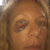 This was the black eye a day after the procedure. The bagginess came on a few days later.